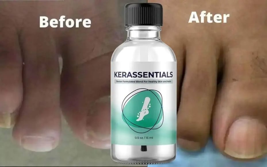 kerassentials-before-and-after-result